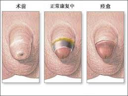 生殖手术